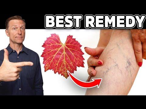 Thumbnail for Venous Insufficiency: This is the Most Effective and Safest Remedy for Varicose Veins
