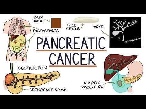 Thumbnail for Understanding Pancreatic Cancer