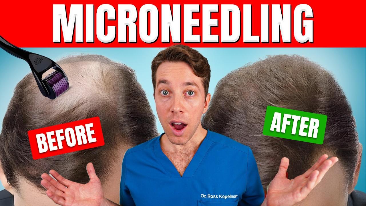Thumbnail for Does Microneedling Actually Regrow Hair? | Hair Surgeon's Advice