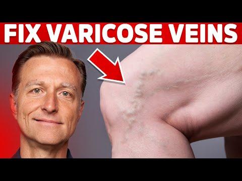 Thumbnail for How to Treat Varicose Veins Naturally – Dr. Berg