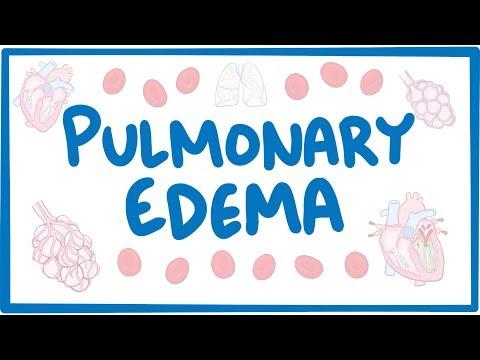 Thumbnail for Pulmonary Edema - causes, symptoms, diagnosis, treatment, pathology